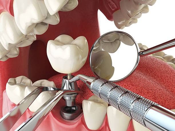 Best Emergency Treatment for Dental Infections or Abscesses in Boling, TX